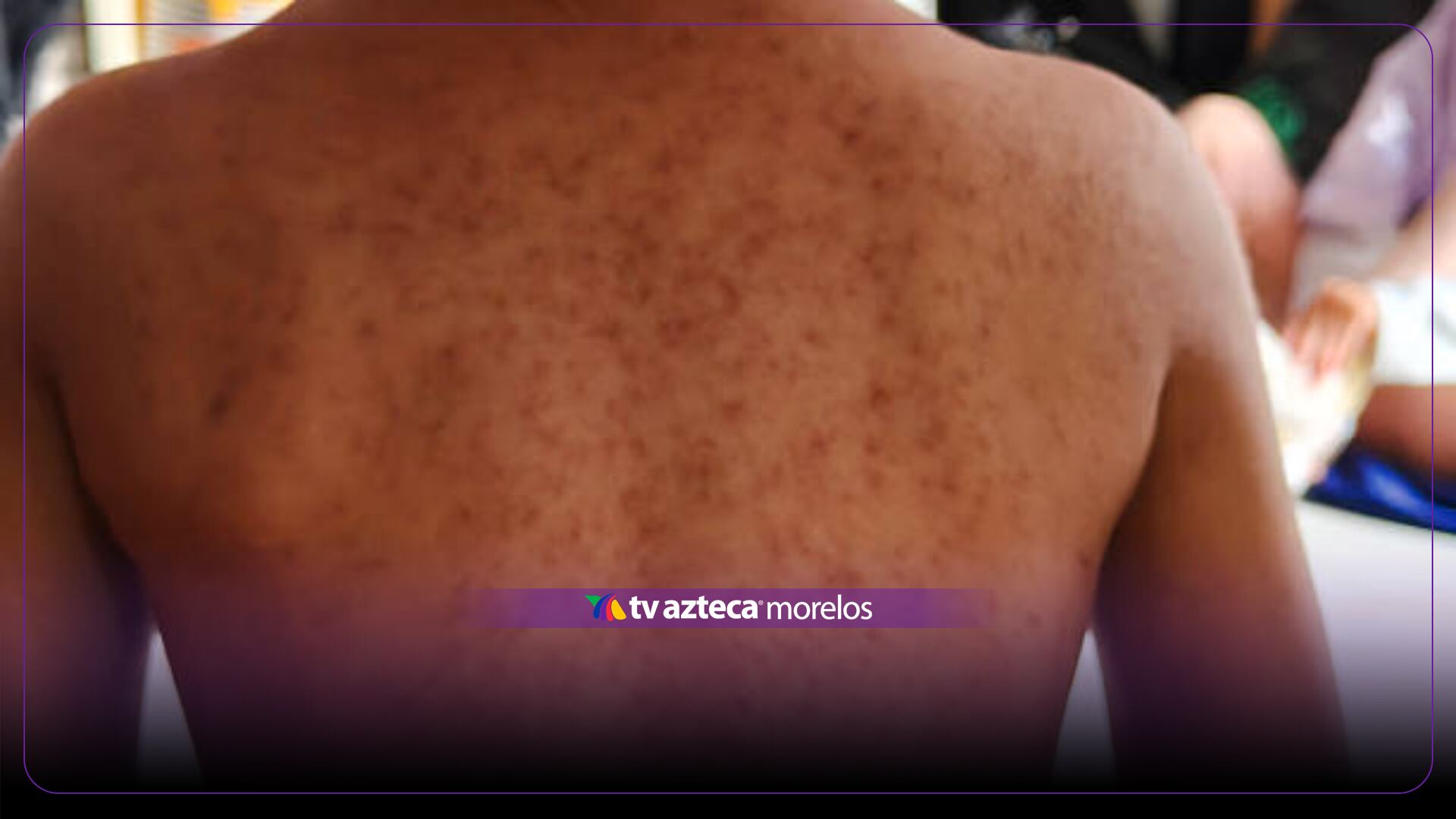 Confirman brote de sarampión y declaran situación de emergencia por contagios
