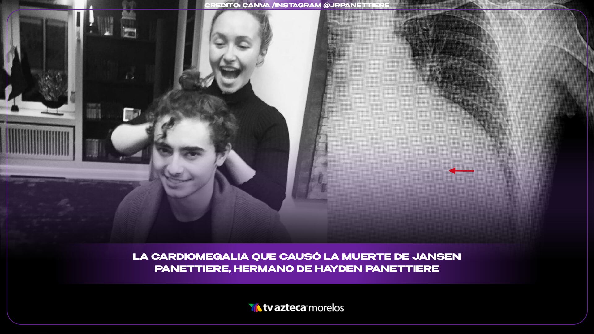 La cardiomegalia que causó la muerte de Jansen Panettiere, hermano de Hayden Panettiere 16.9.png